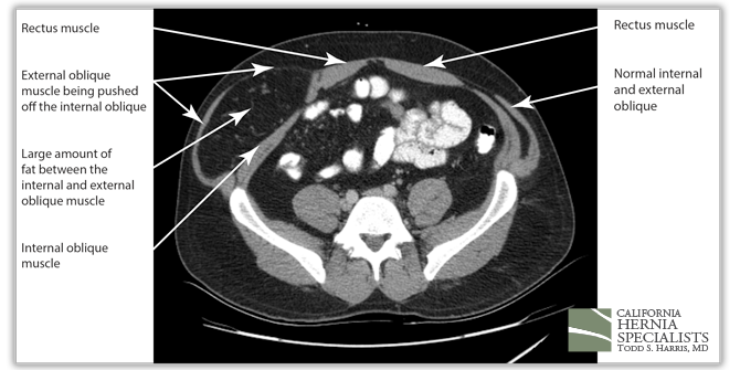 Spigelian Hernia CT image